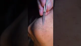 ingrown hair pull out speedx2 with tweezers!  Satisfying 225 #shorts #satisfying  #well  #removal