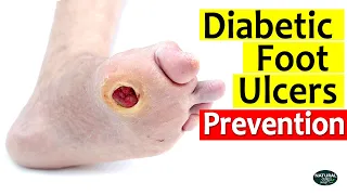 How to Prevent Diabetic Foot Ulcers - Diabetes Management