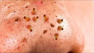 Blackheads New Full Episode 123 today sac dep spa 2022 Relaxing Every Day with sac dep #spa #pimples