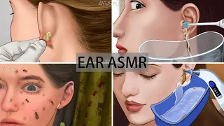 ASMR | Remove ear piercing pus | ear pimple blackhead care|sebaceous cyst removal | Ear cleaning