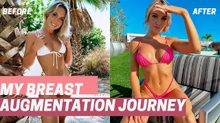 MY BREAST AUGMENTATION JOURNEY | HONEST Q&A |  SURGERY DAY VLOG | EXPERIENCE AND RECOVERY