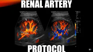 Renal Artery Doppler Protocol - Sonoquickies