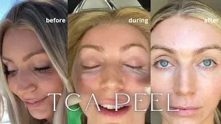 TCA PEEL | PROCEDURE AND RECOVERY PROCESS | BEFORE AND AFTERS | Q&A