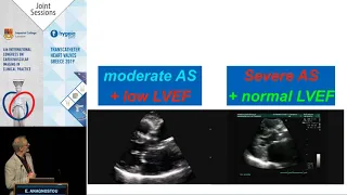 E. Anagnostou | Moderate aortic stenosis with reduced ejection fraction: Can imaging guide therapy?