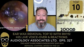 TOP 10 EAR WAX REMOVALS - NUMBER 10