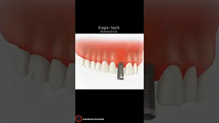 Single-tooth Restoration _ #shorts