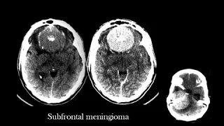 Dr Mamdouh Mahfouz brain imaging Brain tumors Radiology Course