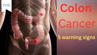 5 warning signs of colon cancer you should never ignore!