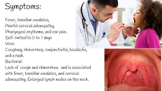 Pharyngitis - Symptoms, causes and Treatment.  Streptococcal pharyngitis