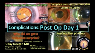 CataractCoach 1394: post-op day one complications after cataract surgery