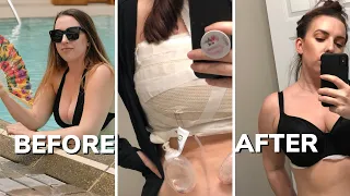BREAST REDUCTION RECOVERY: 1 MONTH UPDATE, SCARS, PAIN, HEALING PROCESS