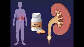 Hydrochlorothiazide and Kidney-Stone Recurrence | NEJM