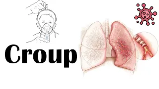 Croup - Causes, Pathogenesis, Signs & Symptoms, Diagnosis, & Treatment