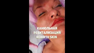 Процедура «выходного дня» – канюльная ревитализация DERLI REBIRTH SKIN