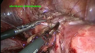 adherent bladder dissection