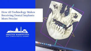 How 3D Technology Makes Receiving Dental Implants More Precise