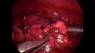 Thoracoscopic repair of Eventration of Diaphargm in 2 months old child left side)