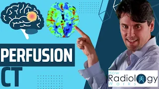 Perfusion CT for Acute Ischemic Stroke