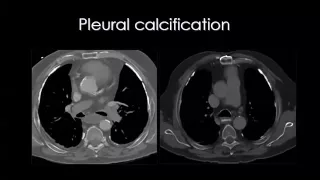 Imaging of Pleural lesions   Prof Dr  Mamdouh Mahfouz In Arabic