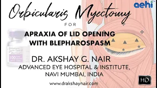 Orbicularis Myectomy / Surgery for Apraxia of Lid Opening / Blepharospasm - Dr. Akshay Nair, AEHI