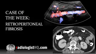 Case of the Week: Retroperitoneal Fibrosis (Ultrasound & CT)
