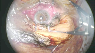 Traction Suture- Trab Revision 3