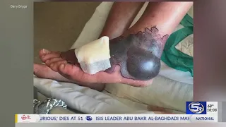 VIDEO: Man nearly loses his foot to flesh-eating bacteria after visiting Florida