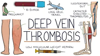 Understanding Deep Vein Thrombosis (DVT)