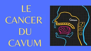 Le cancer du cavum en 5 points