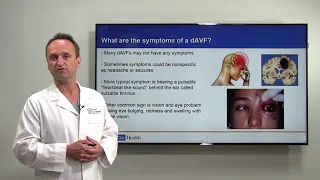 Brain Arteriovenous Fistula: Diagnosis and Treatment | Viktor Szeder, MD, PhD | UCLAMDChat