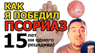 Как я победил ПСОРИАЗ: личный опыт. Мази, таблетки и нервы! Complete cure for psoriasis