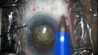 iTrack™ Procedural Steps: Paracentesis / OS Eye