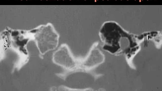 How to read Temporal bone CT scan || for MBBS, PG students