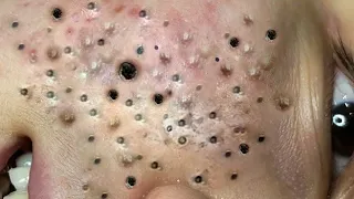 Relax With Blackheads and Acne Treatment 81