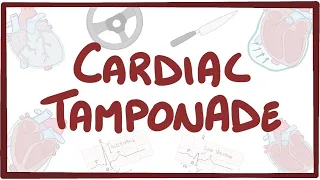 Cardiac tamponade - causes, symptoms, diagnosis, treatment, pathology