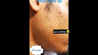 minoxidil beard Journey in just 3 mounts.  beard growth!