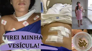 RELATO DE CIRURGIA - COLECISTECTOMIA (RETIRADA DE VESÍCULA) + MOSTREI MINHA CICATRIZ