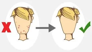 How to Get Rid of Pimples For Teenagers (NO PRODUCTS)