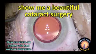 show me a beautiful cataract surgery