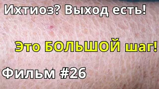 Ихтиоз? Выход есть! Фильм#26. Это БОЛЬШОЙ шаг!