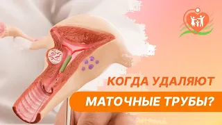 👉 Когда удаляют маточные трубы?