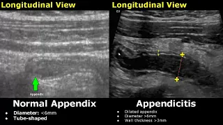 Appendix Ultrasound Normal Vs Abnormal Image Appearances | Appendicitis USG Scan