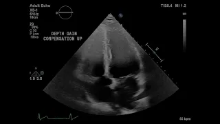 Echographie cardiaque - Partie 1 - Optimaliser l'image