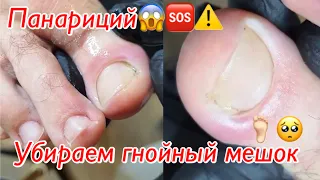 Панариций😱🆘⚠️🦶🏻 • Убираем гнойный мешок🦶🏻🥺