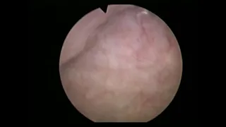 En bloc резекция стенки мочевого пузыря с опухолью (лейомиома)