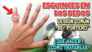 ESGUINCE EN LOS DEDOS | LESIÓN DE PORTERO ¿COMO TRATARLA? | Tips para Porteros