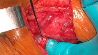 Nerve Monitoring in Head Neck Surgeries - OM 5.0 (ONCO SURGERY MASTER COURSE)