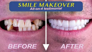 REAL review of All on 4 Transformation | David's Dental Implants