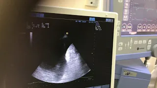 A very simple and accurate way of measuring the amount of pleural effusion by US [live video].