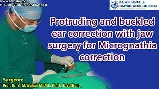 Protruding and buckled ear correction with jaw surgery for Micrognathia correction